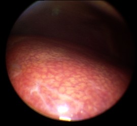 steatosis1
